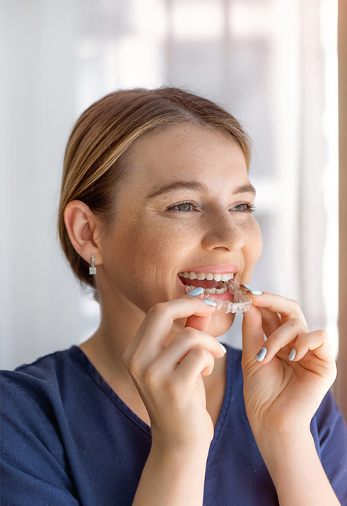 Invisalign Aligners